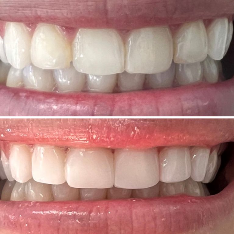 Bioclear-BandA-12