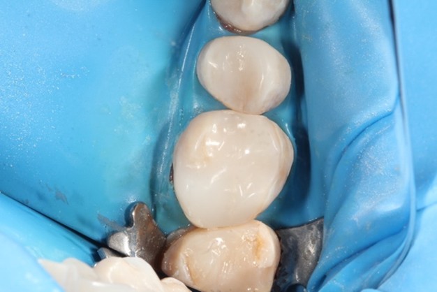 Bioclear-after