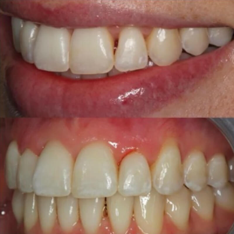 Fixing-Black-Triangles-between-teeth